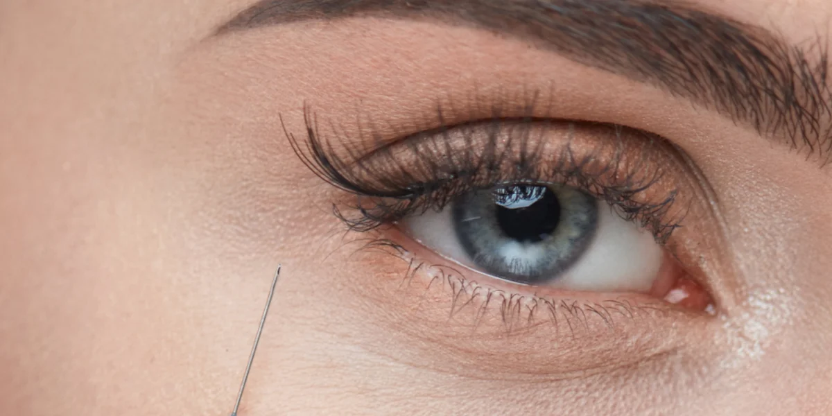 Microcânula fill·k sendo aplicada na região periorbital